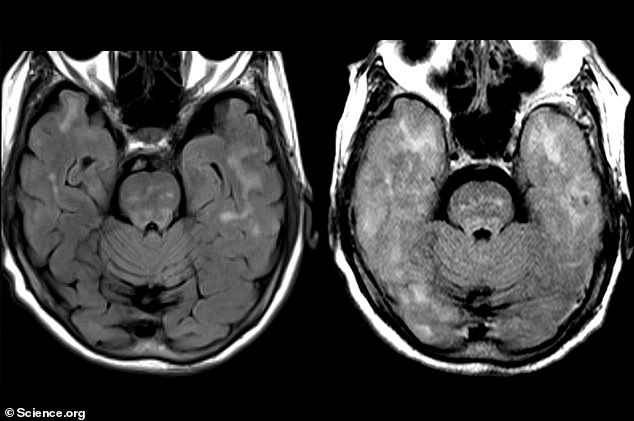 تظهر الفحوصات أعلاه دماغ المرأة قبل العلاج بالجسم المضاد (على اليسار) وبعد ذلك (على اليمين).  انتفخ دماغها أثناء العلاج وظهرت عليها علامات النزيف