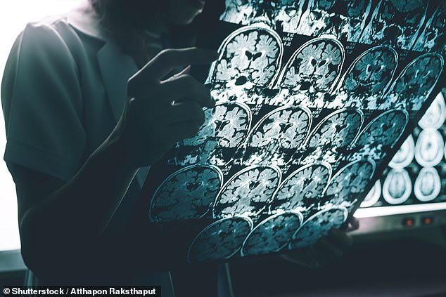 طبيب يبحث في التصوير بالرنين المغناطيسي لأشعة الدماغ لمرضى الزهايمر.  اكتشف العلماء في معهد ماساتشوستس للتكنولوجيا علاجًا بنتائج 