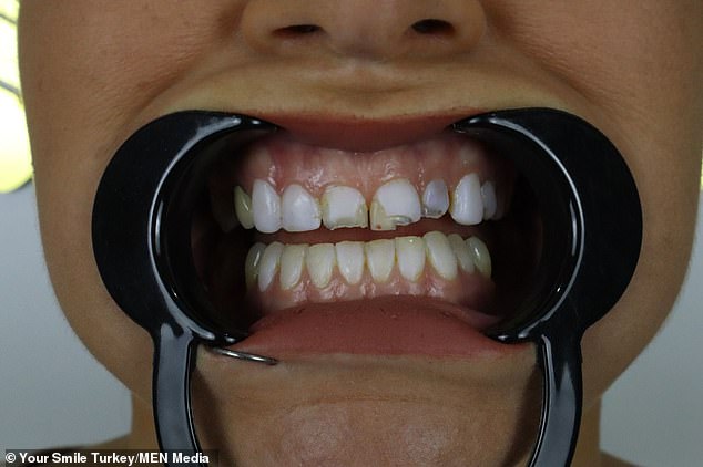 أخبرها طبيب أسنان جايد أن لديها ثلاثة أسنان مكسورة وتحتاج أيضًا إلى قناة جذر عاجلة - لكنها لم تستطع تحمل تكاليف إصلاحها في ربطة العنق