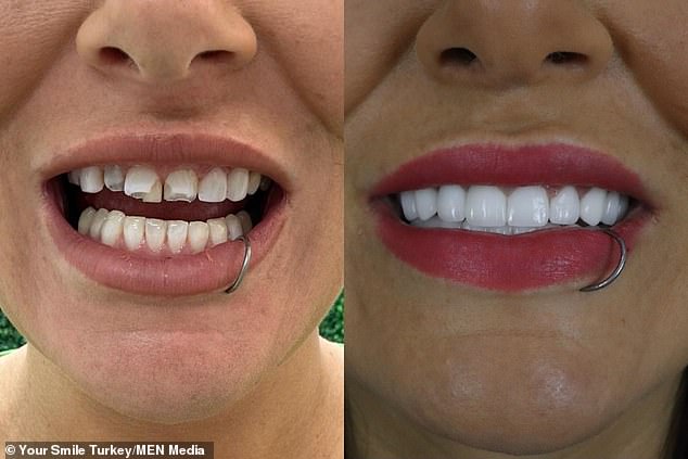إلى اليسار: كيف بدت أسنان Jade عندما وصلت إلى العيادة.  على اليمين: تم تركيب قشرة Jade الجديدة في تركيا