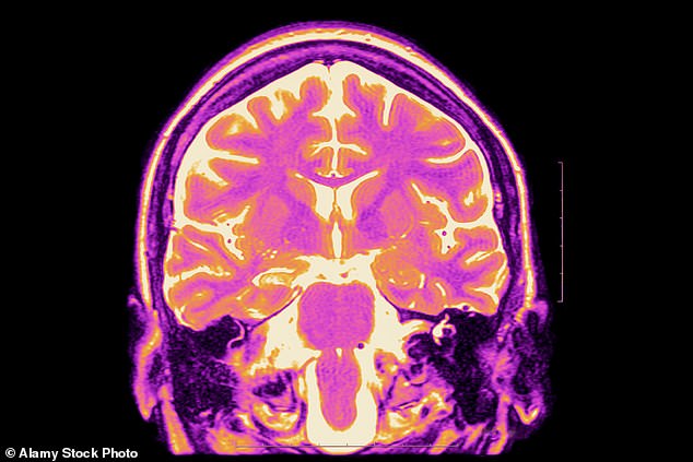 يقول العلماء إن الاختبارات الحديثة التي أجريت على الحيوانات تشير إلى أن الابتكارات يمكن أن تكون بمثابة علاج محتمل (صورة مخزنة لـ MRIS للدماغ المصاب بالصرع)