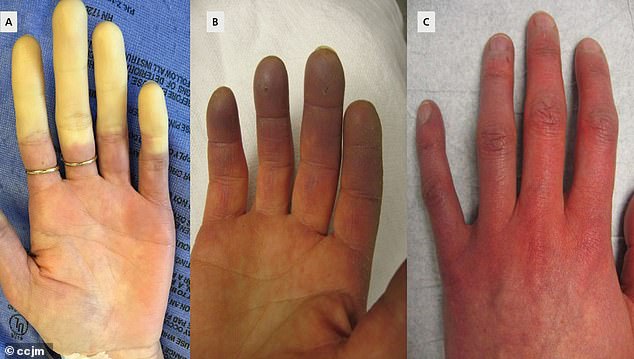 عندما تظهر أعراض رينود لأول مرة، تتحول الأصابع إلى اللون الأبيض بسبب تقييد تدفق الدم.  عندما تفقد الأنسجة الأكسجين، ستتحول الأصابع إلى اللون الأزرق.  ومع عودة تدفق الدم، تتحول الأصابع إلى اللون الأحمر وقد يعاني الأشخاص من وخز و/أو تورم و/أو خفقان مؤلم