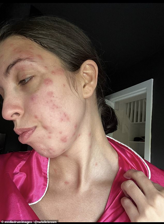 ناتالي براون (في الصورة)، 28 عاما، تعرضت للدغات بق الفراش بعد أن أمضت ثلاثة أيام في إجازة في بينيدورم، إسبانيا.