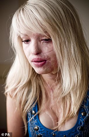 عانت كاتي (في الصورة عام 2009) من إصابات خطيرة وعمى في إحدى عينيها بعد أن تعرضت لهجوم بالحمض من قبل صديقها السابق دانييل لينش وشريكها ستيفان سيلفستر في عام 2008.