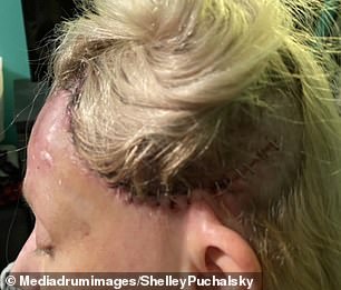 وبعد أن تعثرت أثناء الجري، قادت السيدة بوشالسكي نفسها إلى أقرب مستشفى وكانت الدماء تسيل على وجهها واضطرت إلى إجراء أكثر من 40 غرزة.