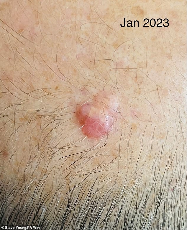 السيد يونغ، في الصورة في يناير 2023 مع سرطان الجلد على رأسه