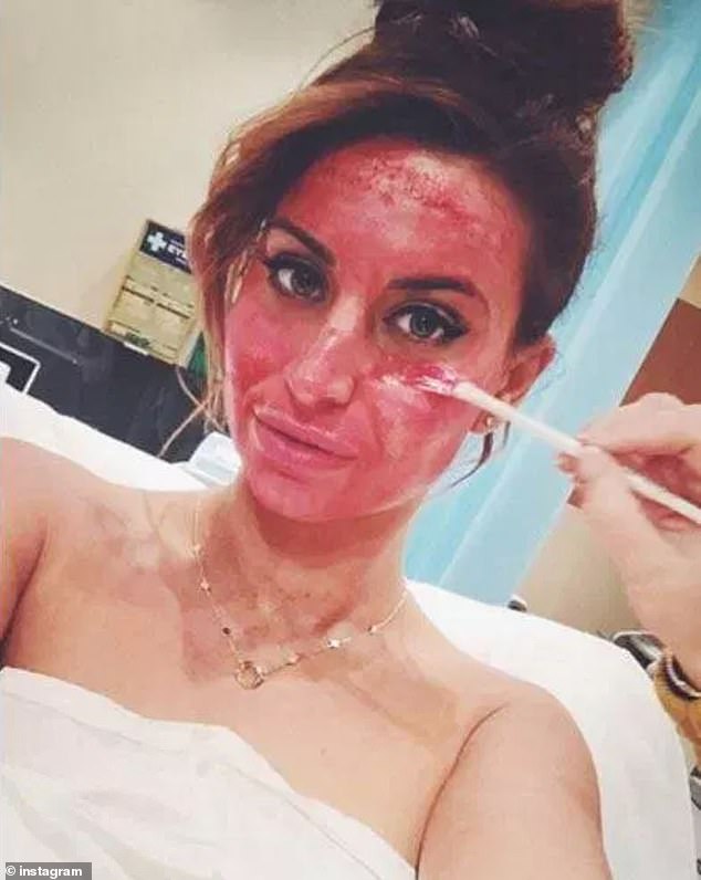 خضعت فيرن ماكان أيضًا لعملية تجميل الوجه لمصاصي الدماء، وحصلت على الإجراء في عام 2016 لتجديد وجهها.