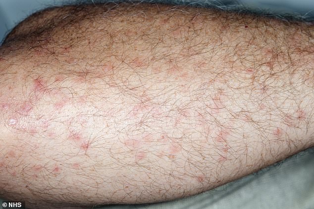 تظهر لدغات البراغيث على الجلد على شكل بقع صغيرة مرتفعة، ويمكن أن تتطور أحيانًا إلى بثور مملوءة بالسوائل (في الصورة)